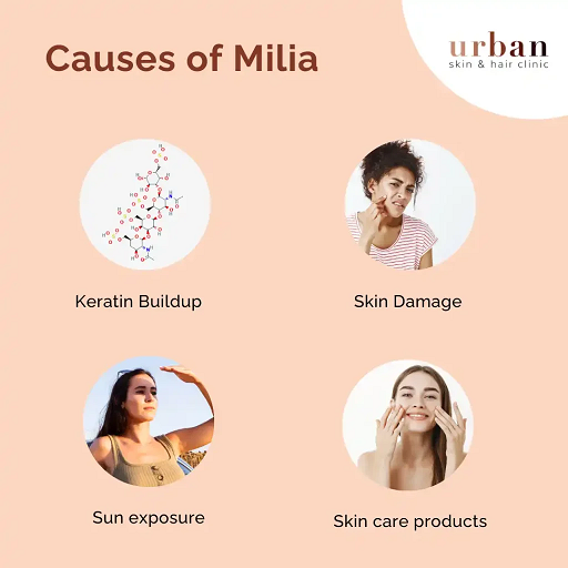 What is the Main Cause of Milia